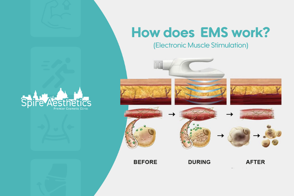 EMS treatment for post pregnancy weight loss treatment Berkhamsted