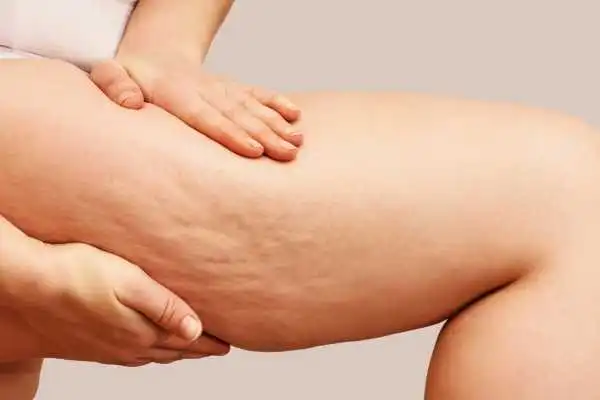 Image of woman showing leg with cellulite Berkhamsted