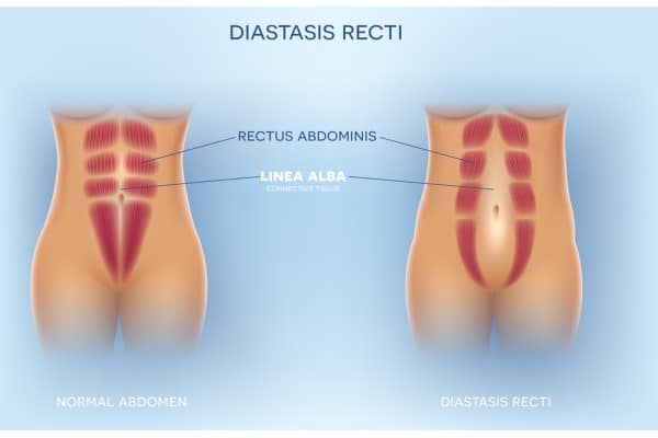 How Does Non-Surgical Treatment Help With Loose Skin, Weak Abdominal Muscles and Post-Pregnancy Changes Berkhamsted?