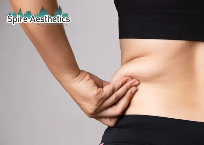 Image of woman pinching fat on their hips Berkhamsted. Fat Freezing treatment