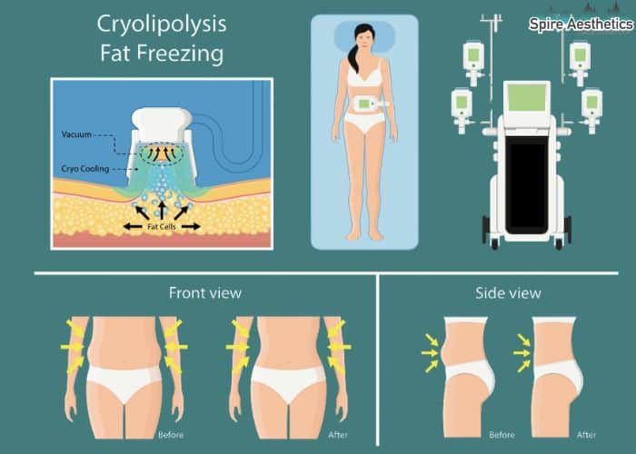 Image of diet and fat freezing combined for best results for Spire Aesthetics Berkhamsted