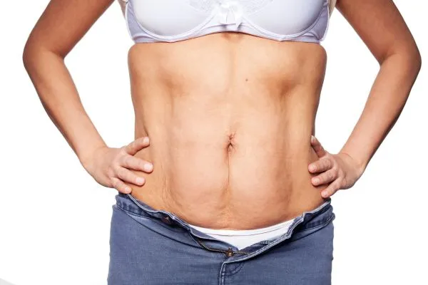 sagging skin on woman's stomach after weight loss injections Berkhamsted
