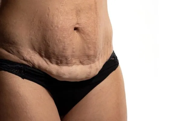 Image of womans stomach after weight loss injections Berkhamsted showing saggy skin