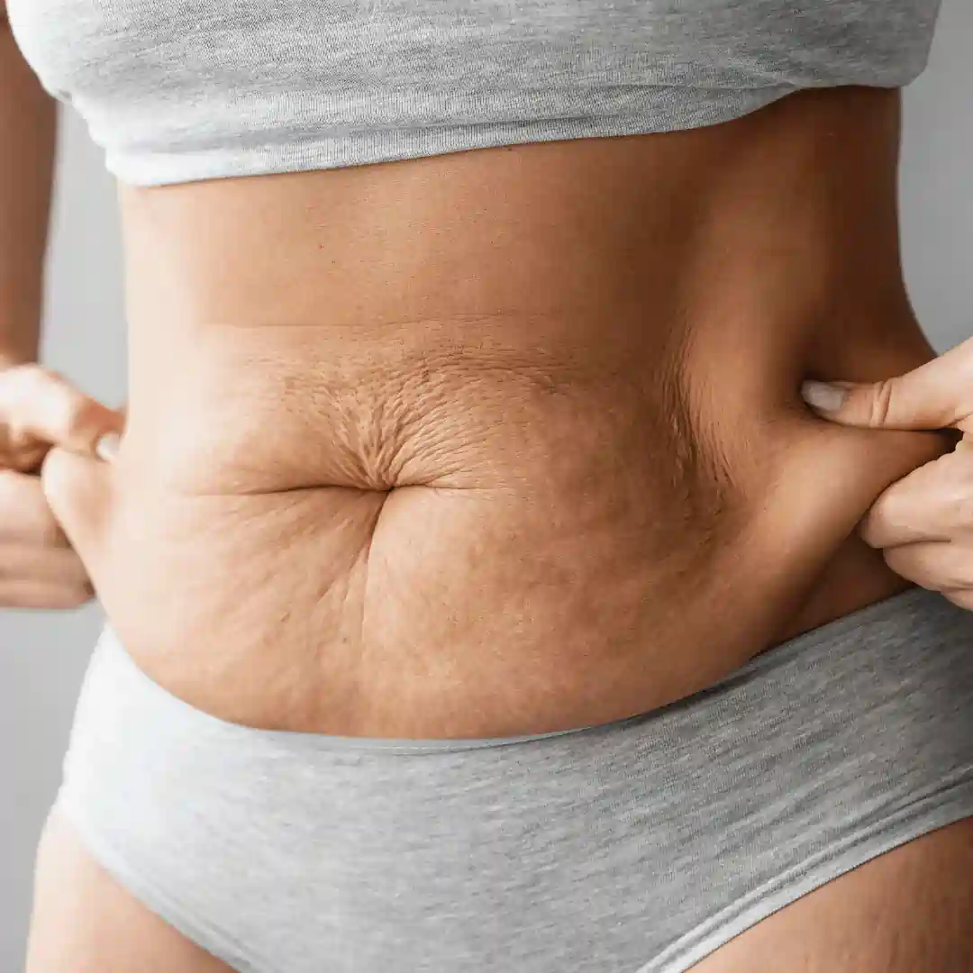 Is It Normal to Have Loose Skin After Pregnancy Berkhamsted?