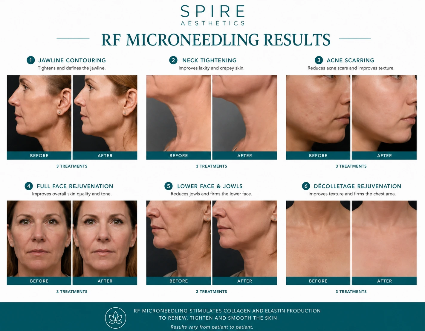 RF Microneedling Skin tightening Berkhamsted results