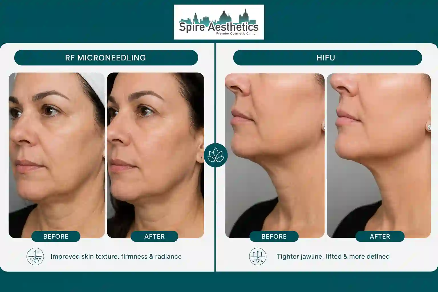 Can RF Microneedling and HIFU Be Combined Berkhamsted?
