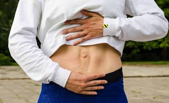 When Could Diastasis Recti Be the Missing Piece of the Puzzle Berkhamsted?