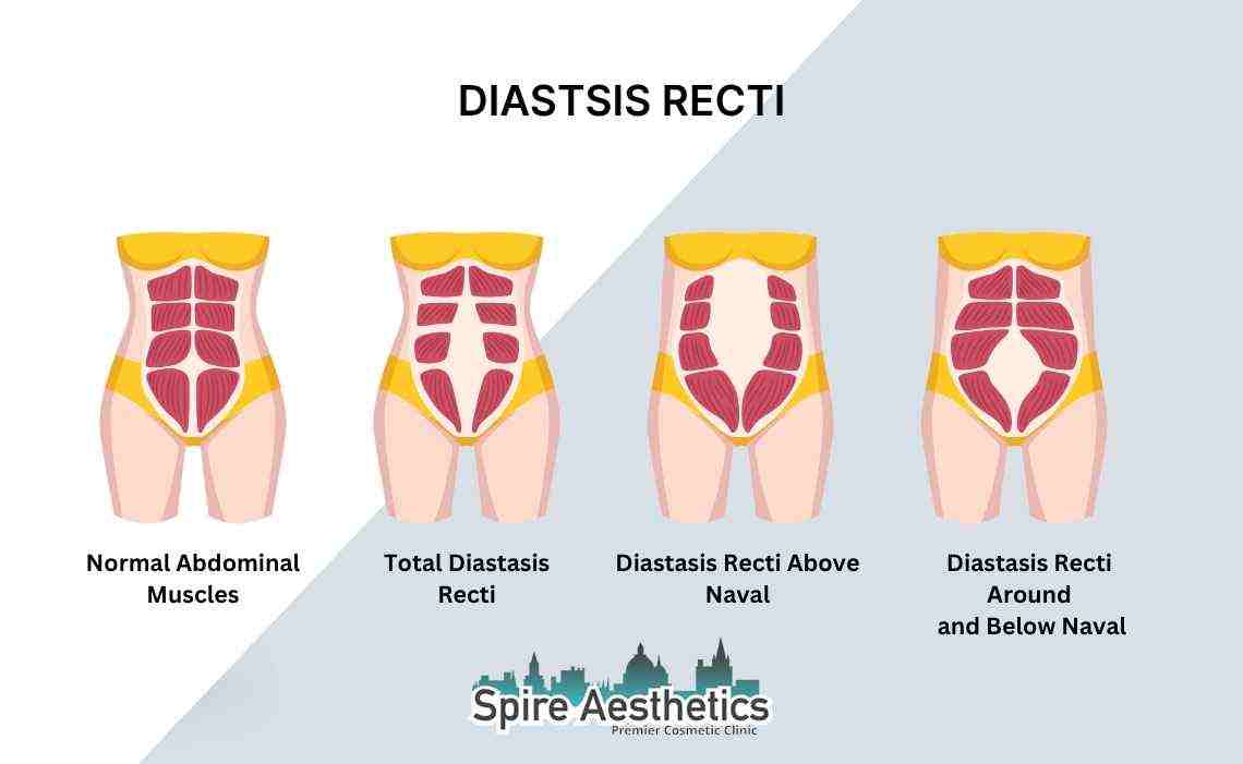 Is Non-Surgical Diastasis Recti Treatment Right for You? Common Concerns Answered Berkhamsted